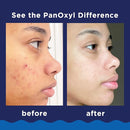 Panoxyl Acne Foaming Wash 10% Benzoyl Peroxide Maximum Strength, (156 G)