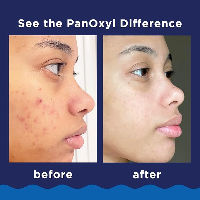 Panoxyl Acne Foaming Wash 10% Benzoyl Peroxide Maximum Strength,  (156 G)